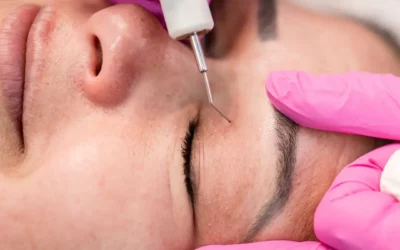 Plasma froid à Chaumont : la solution non invasive pour effacer cicatrices et vergetures